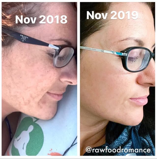 Lissa showing before and after pics of acne